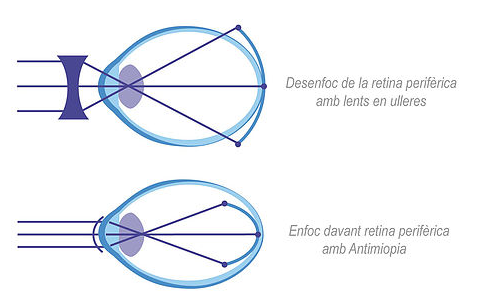 Amiopik. Una solució per a la progressió de la miopia.